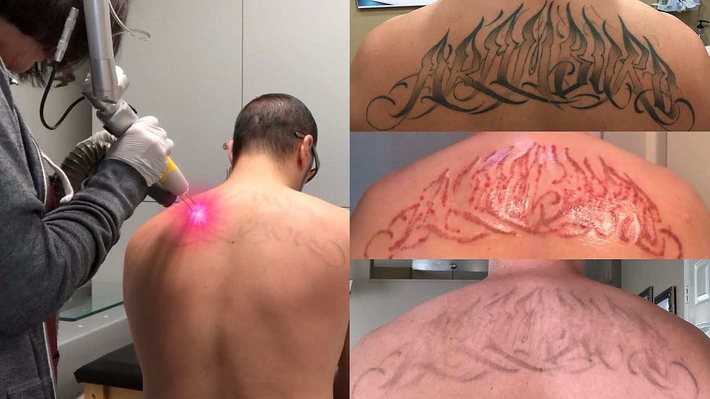 Laser Tattoo Removal in Fairbanks | Revive Medical Spa