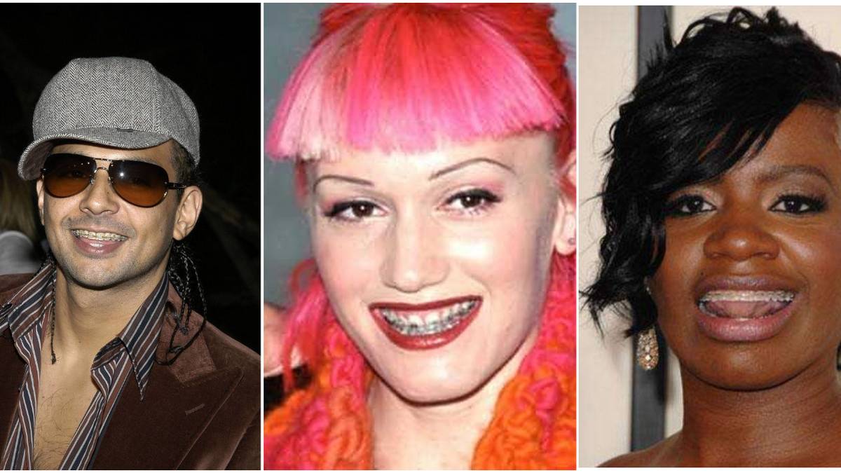 10 Celebrities Who Wore Braces As Adults