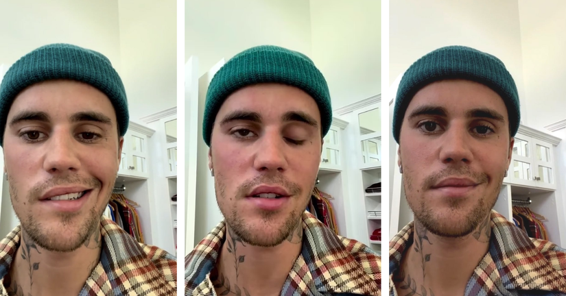 How Did Justin Bieber's Face Get Better After Suffering From Facial ...