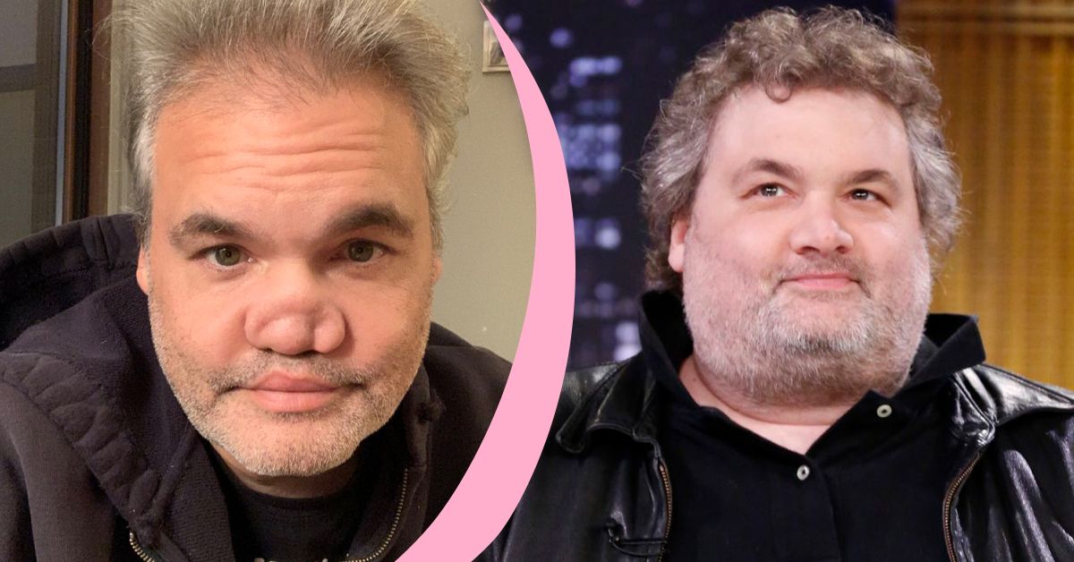 Artie Lange nose before and after
